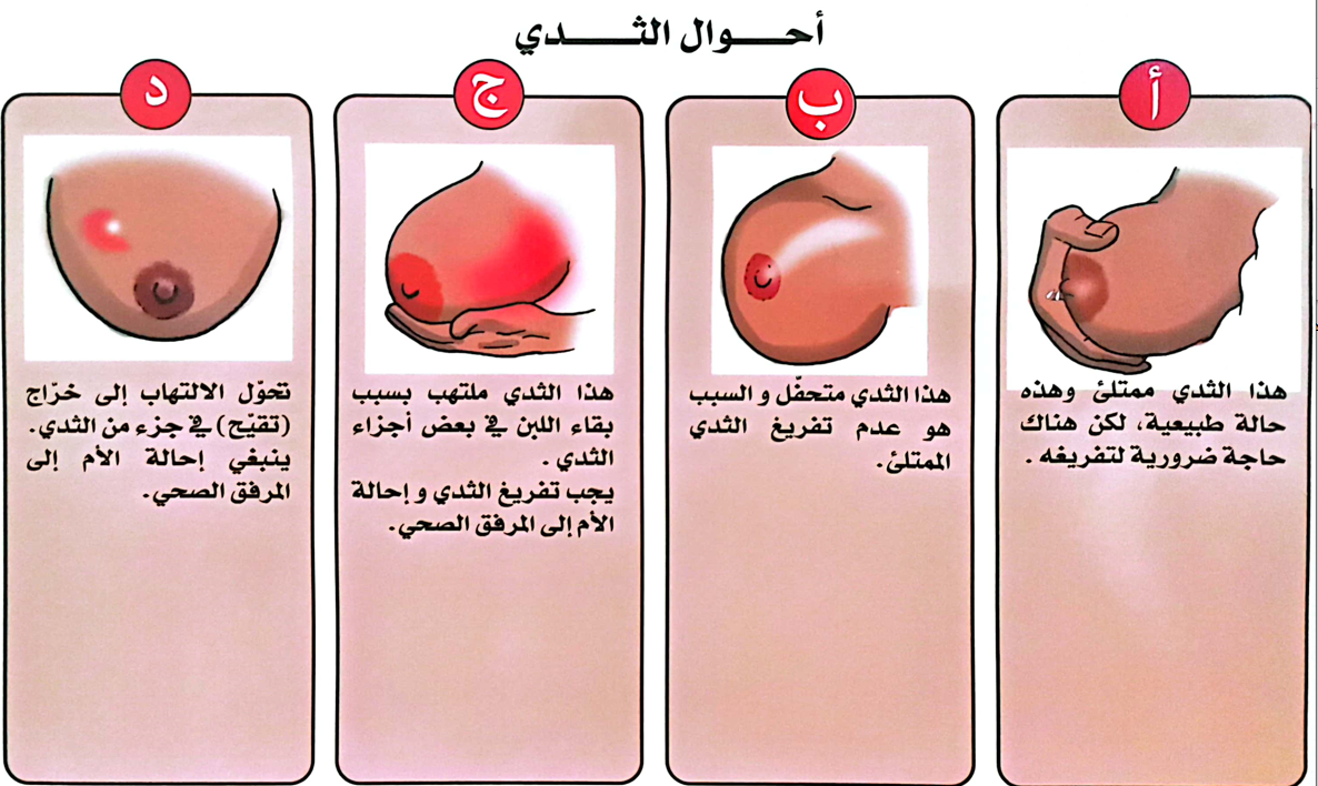 احزال الثدي2.png