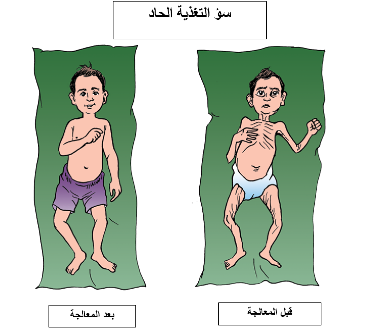 سؤ التغذية الحاد.png